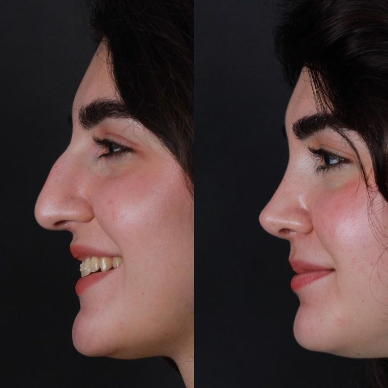 Conchaplastie in Antalya