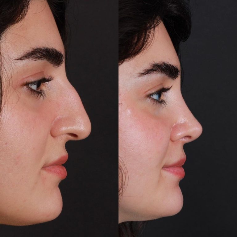 Revisions-Nasenkorrektur