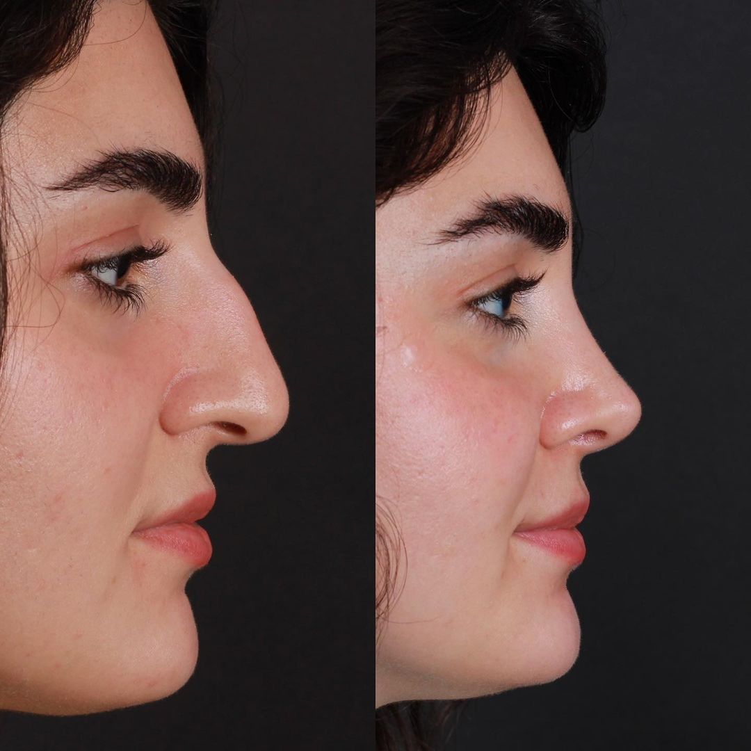 Revisions-Nasenkorrektur