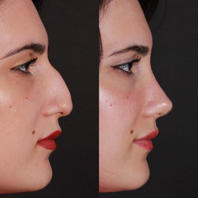 Septoplasty in Turkey