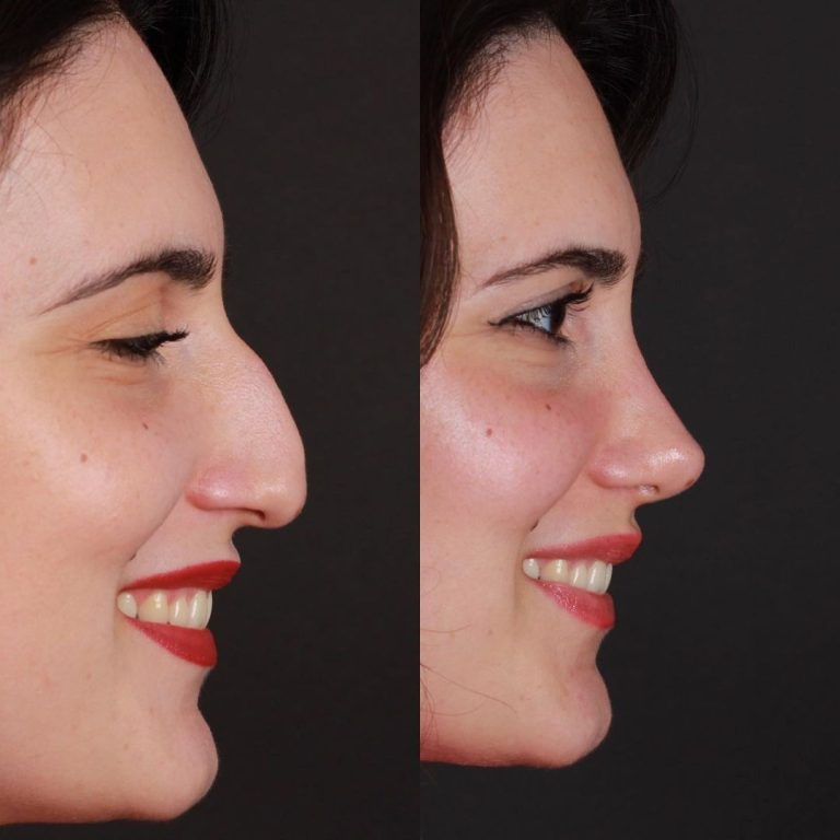 closed rhinoplasty in Antalya