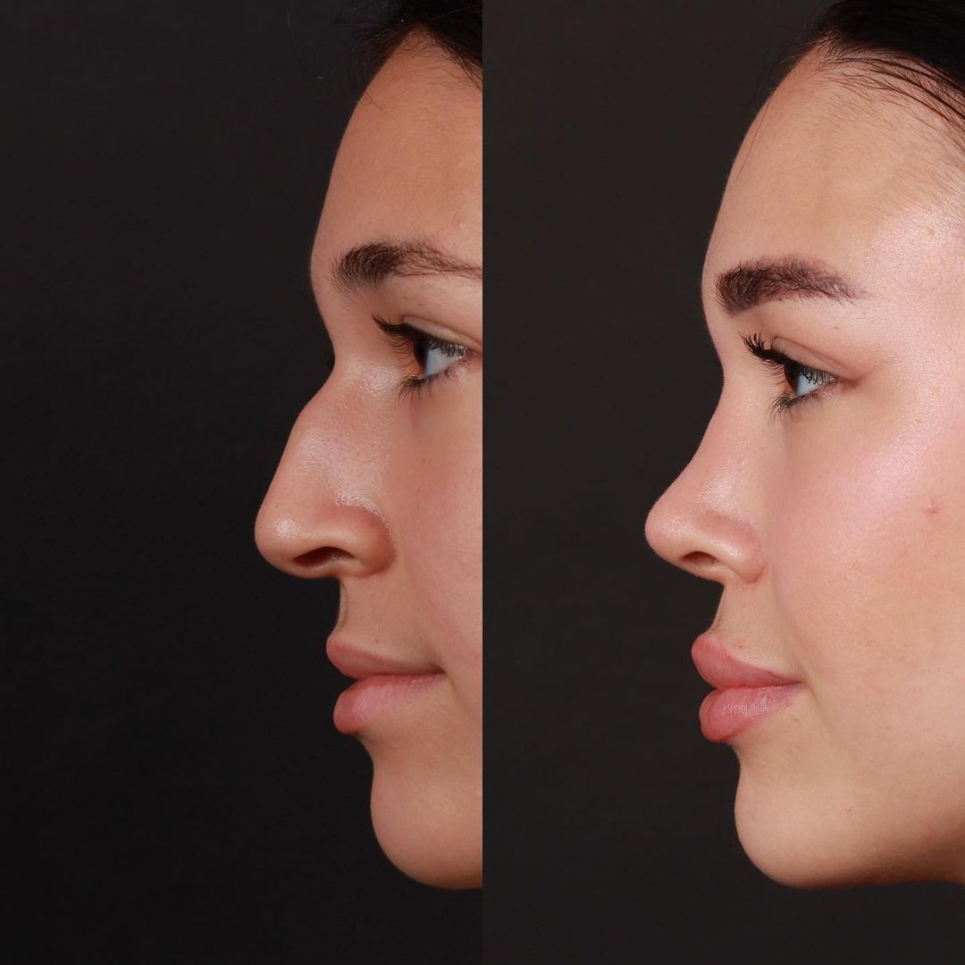 Funktionellen Nasenchirurgie