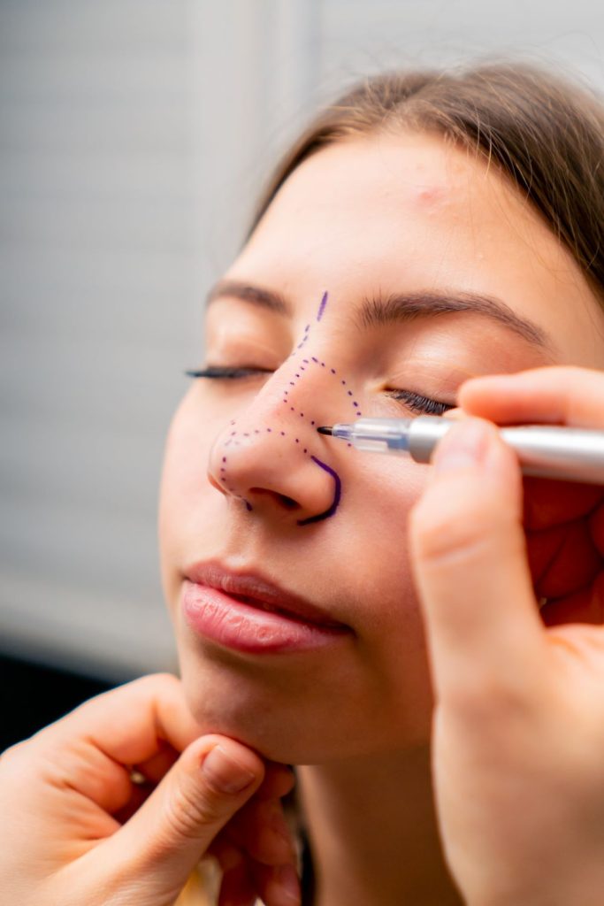 Open Rhinoplasty in Antalya
